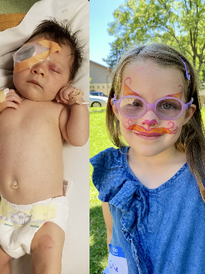 Our congenital cataract warrior! Julia from 2019 --> 2024